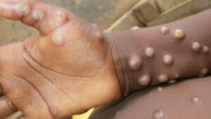 monkeypox Monkeypox
