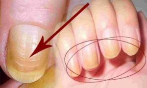 1444052 nails नाखूनों से जानिये आपके स्वास्थ्य का हाल